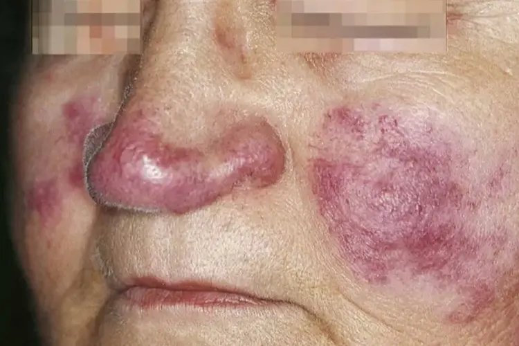 轻度红斑狼疮图片