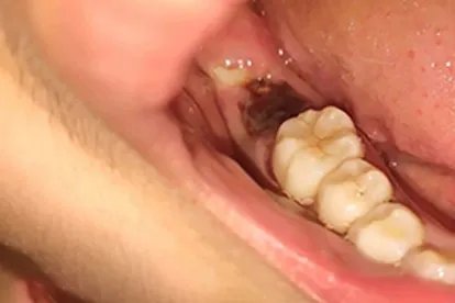 拔牙后七天窟窿恢复图