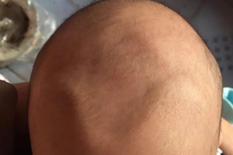 婴儿前囟门凹陷图片