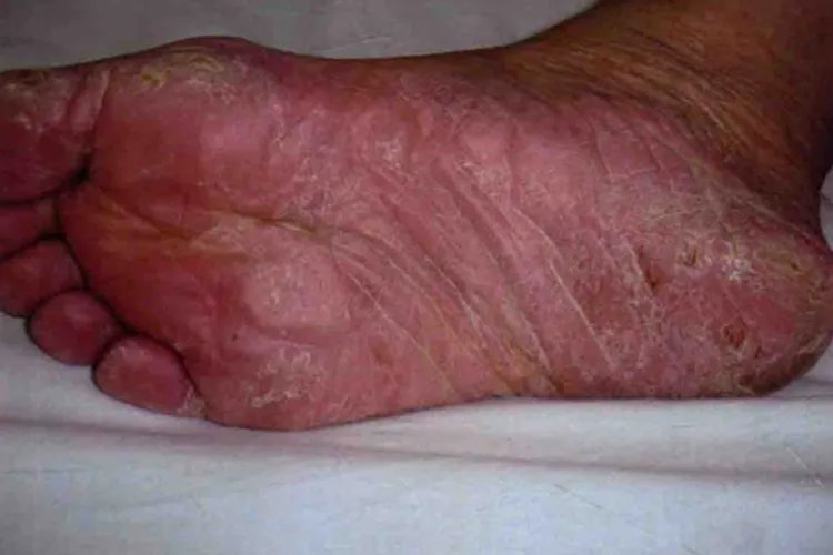 脚部皮炎图片和症状