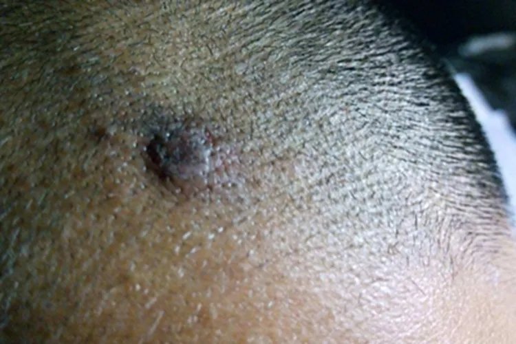 黑素瘤症状图片