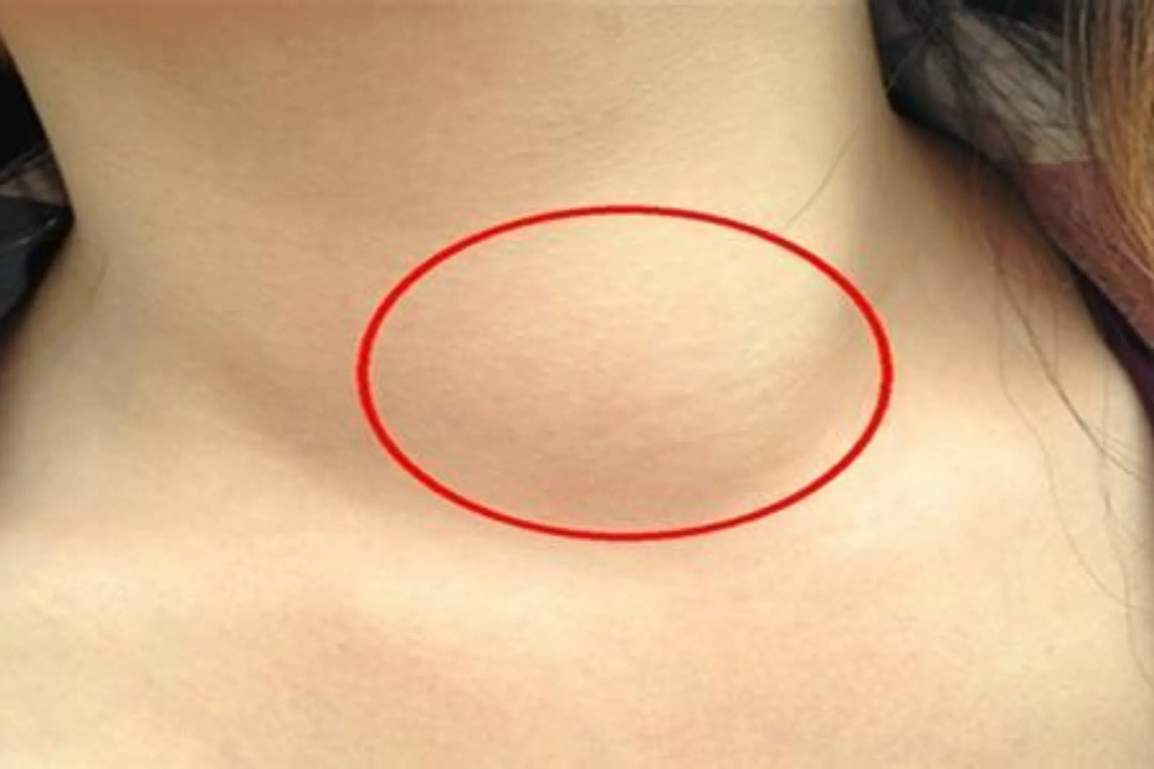 颈部淋巴结肿大图片，怎么消除