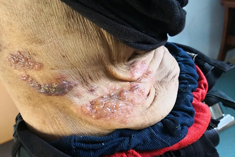 蜘蛛疮长什么样子