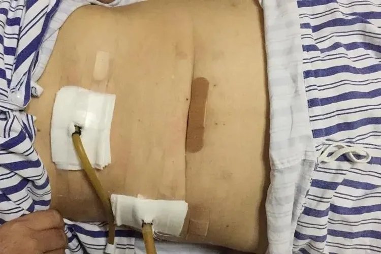 白血病人清创伤口图片