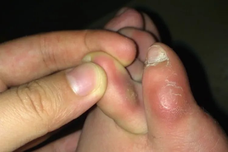 脚鸡眼初期图片