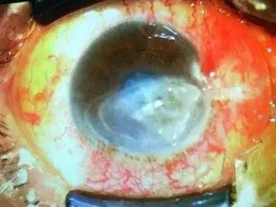 真菌性角膜炎症状图片