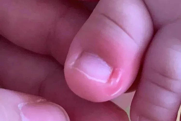 三个月宝宝甲沟炎图片