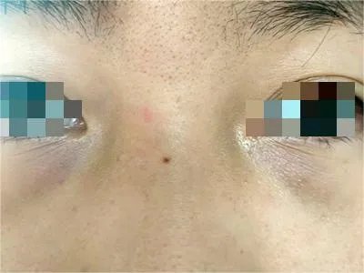 交界痣黑痣图片