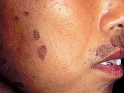 扁平苔藓斑图片