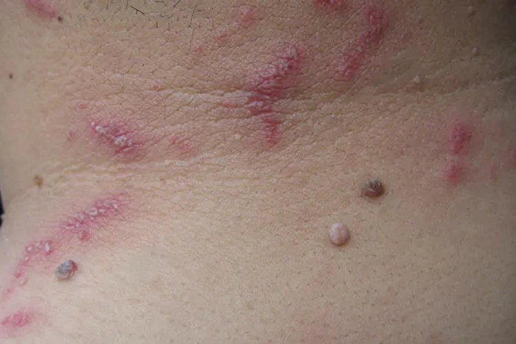 隐翅虫咬伤的图片