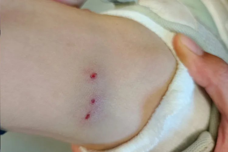 丘疹性荨麻疹的初期症状图片