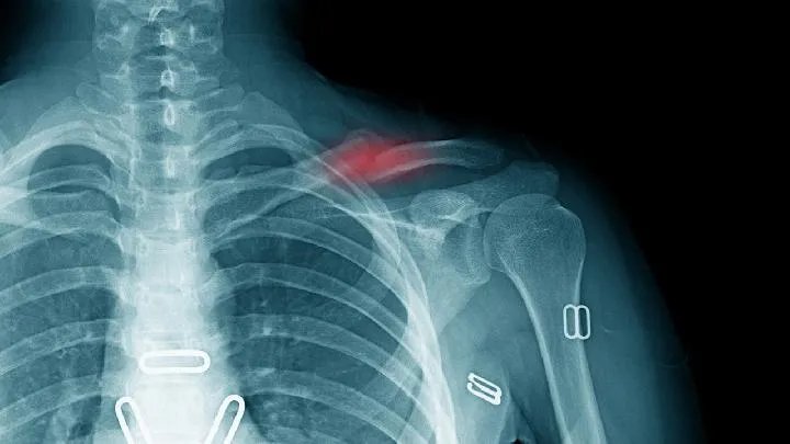 锁骨骨折的检查有哪些