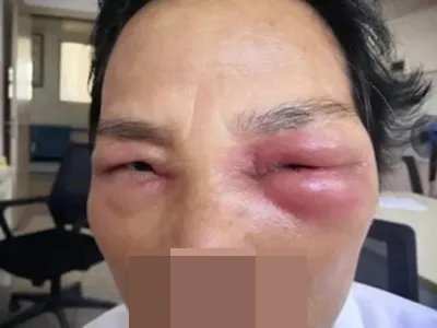 蜂窝织炎红肿图片