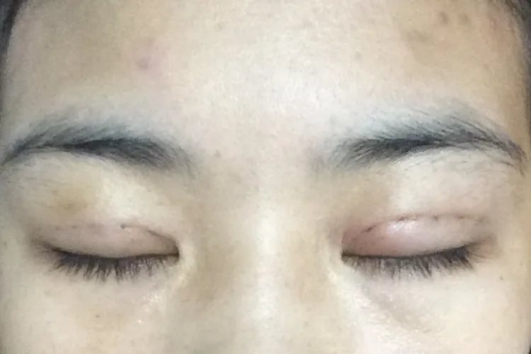 埋线双眼皮图片
