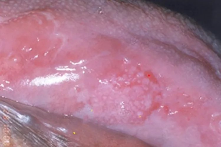 外阴白色病变症状图片