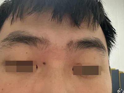 交界痣黑痣图片