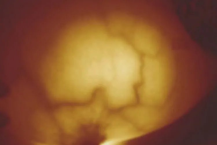 红外线乳腺正常图片