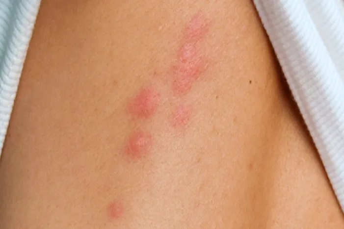 臭虫图片咬人后图片