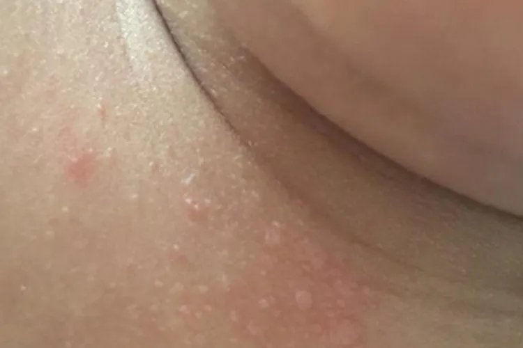 汗疱疹症状图片