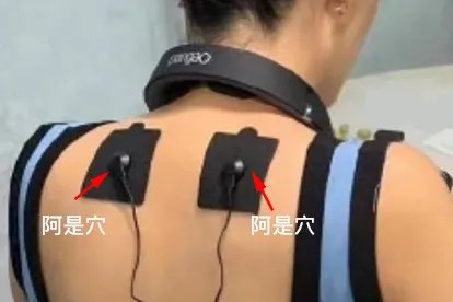 颈椎理疗仪贴片位置图