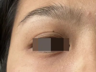 交界痣黑痣图片