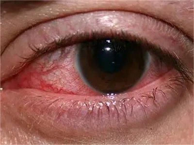 真菌性角膜炎症状图片