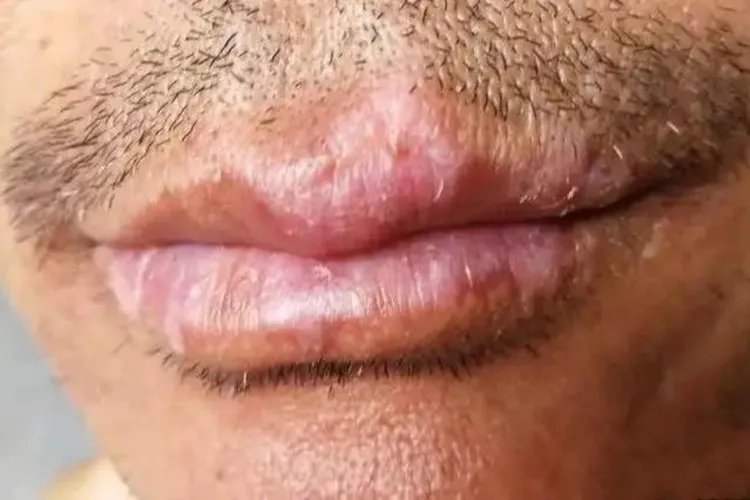 唇部盘状红斑狼疮图片