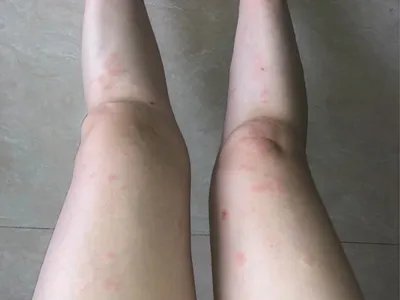 运动诱导性荨麻疹症状图片