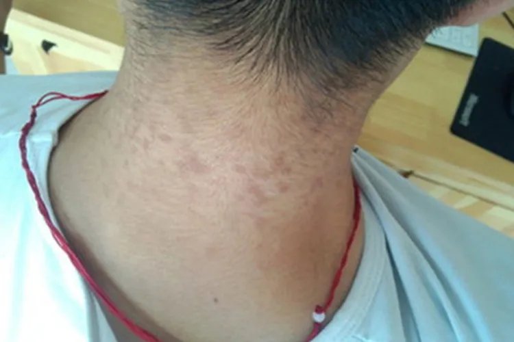 脖子上花斑癣图片大全