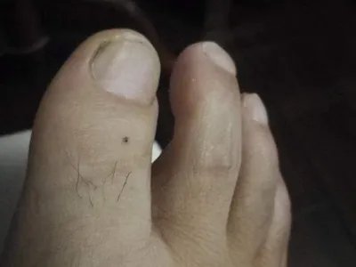 交界痣黑痣图片