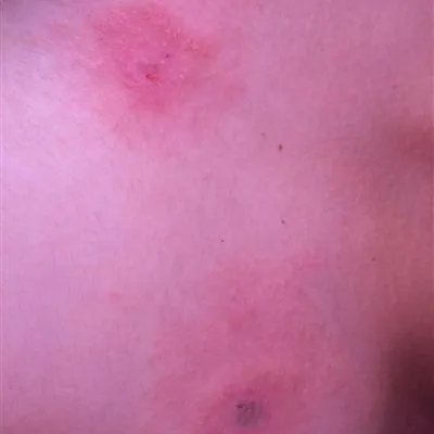 韦格纳肉芽肿怎么得的?