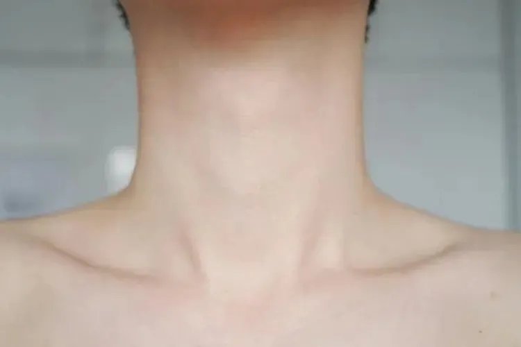 正常脖子和甲状腺肿大图片