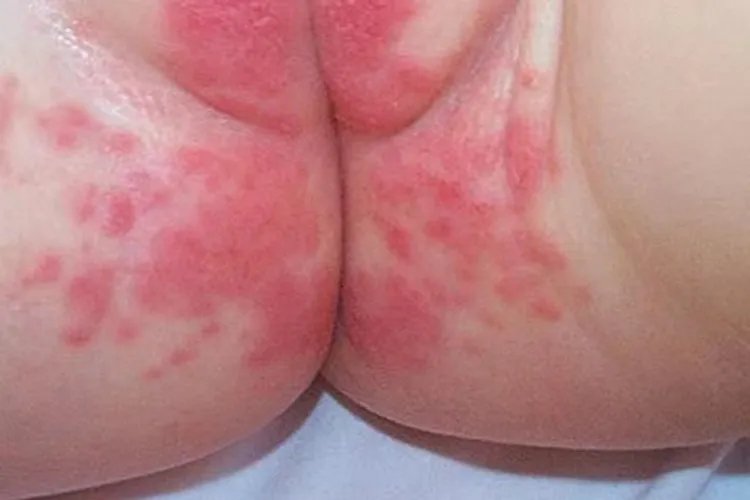 宝宝尿布疹图片