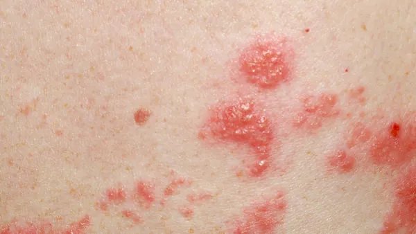 带状疱疹传染吗