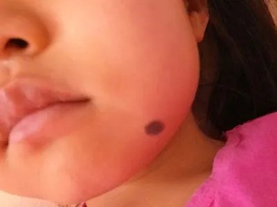 交界痣黑痣图片