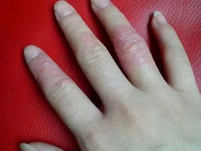 手部湿疹红斑图片