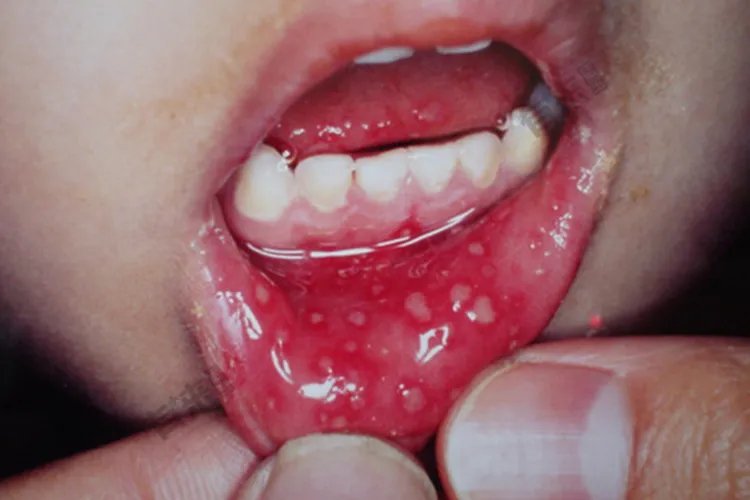 小儿手足口病最早期图片