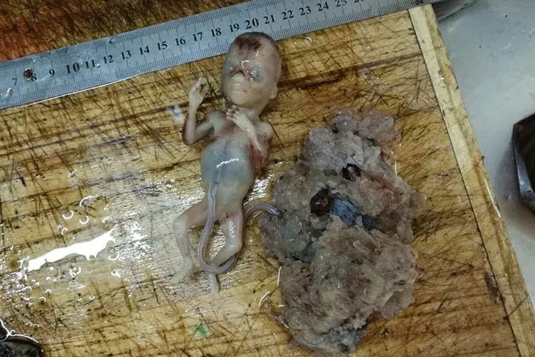 葡萄胎婴儿真实图片