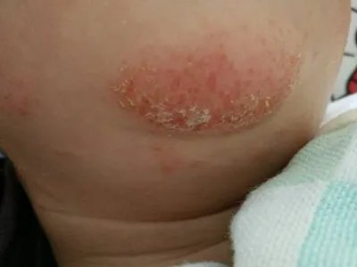 奶癣小红疙瘩图片