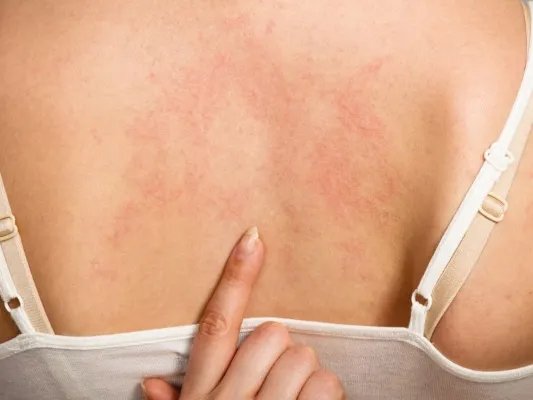 湿疹止痒的方法