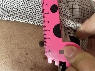 交界痣黑痣图片