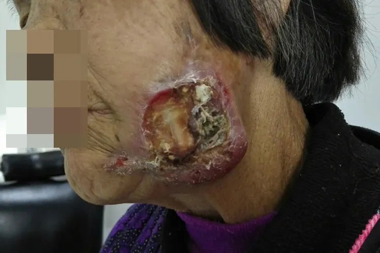 面部鳞状细胞癌图片