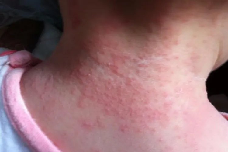 小皮疹图片大全