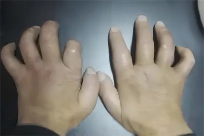 麻风病患者图片