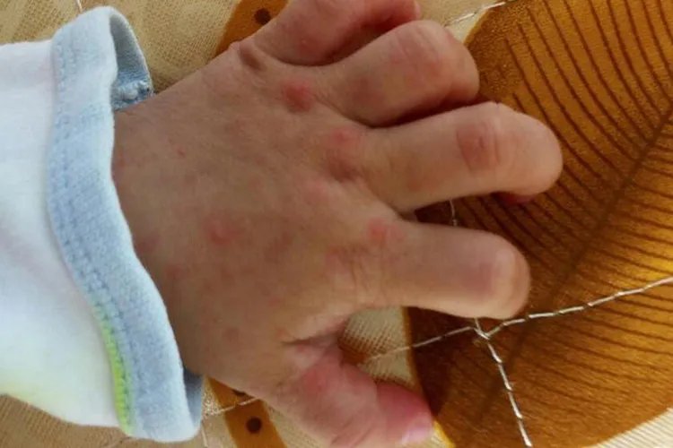 手足口病是什么症状图片