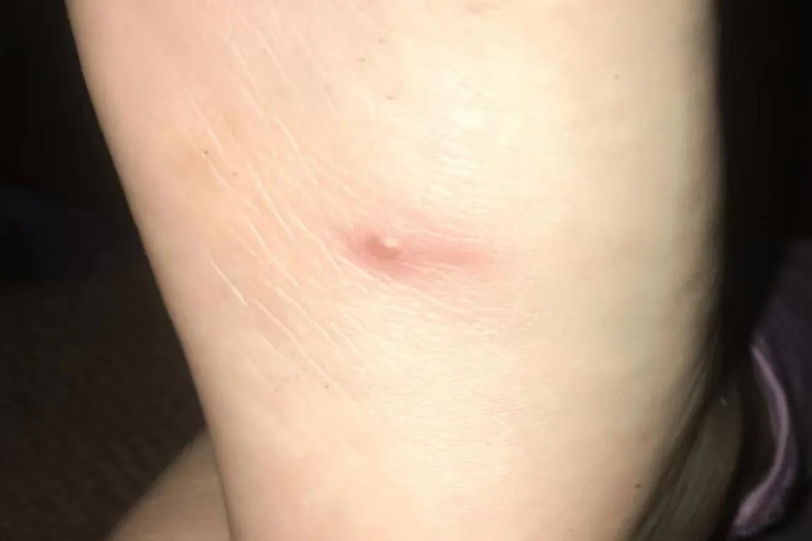 腋下粉瘤的图片