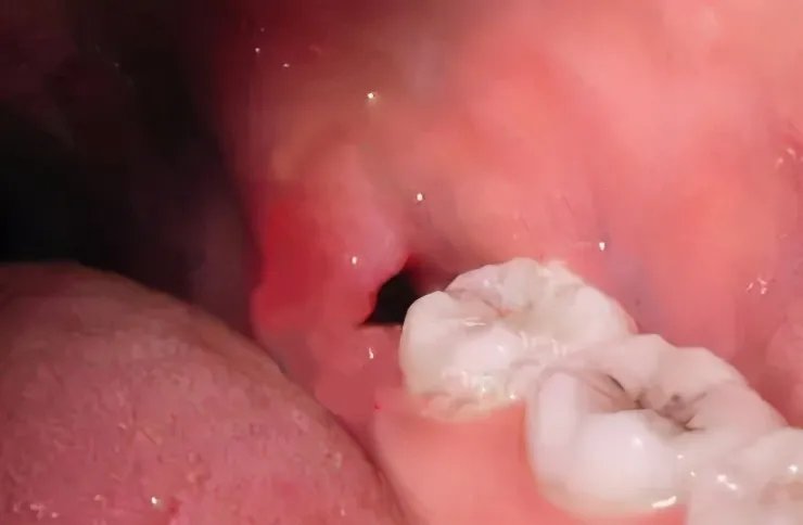 拔牙后七天窟窿恢复图