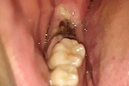 拔牙后七天窟窿恢复图