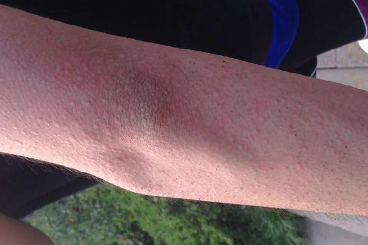 5种荨麻疹症状分析图片