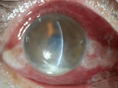 真菌性角膜炎症状图片